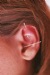 דיקור אוזן מסייע להליך ההרזייה